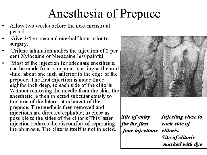 Anesthesia of Prepuce • Allow two weeks before the next menstrual period. • Give