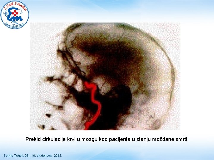 Prekid cirkulacije krvi u mozgu kod pacijenta u stanju moždane smrti Terme Tuhelj, 08. Prekid cirkulacije krvi u mozgu kod pacijenta u stanju moždane smrti Terme Tuhelj, 08.