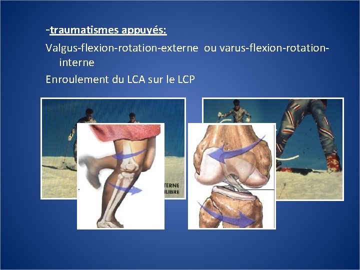 -traumatismes appuyés: Valgus-flexion-rotation-externe ou varus-flexion-rotationinterne Enroulement du LCA sur le LCP 