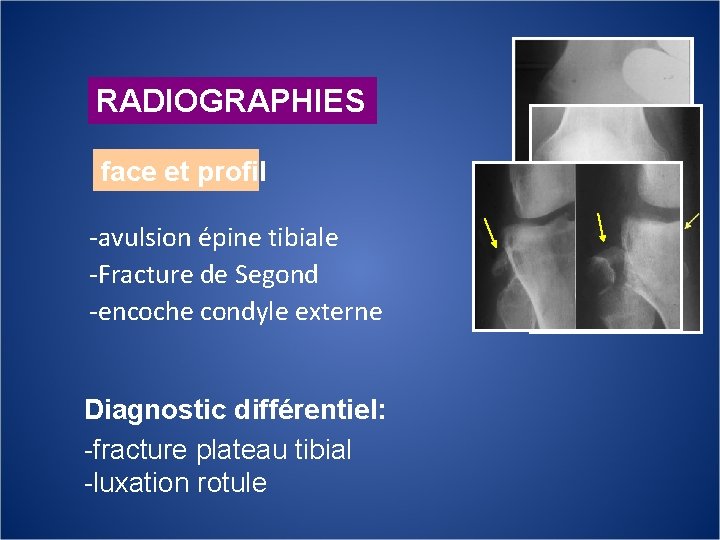 RADIOGRAPHIES face et profil -avulsion épine tibiale -Fracture de Segond -encoche condyle externe Diagnostic