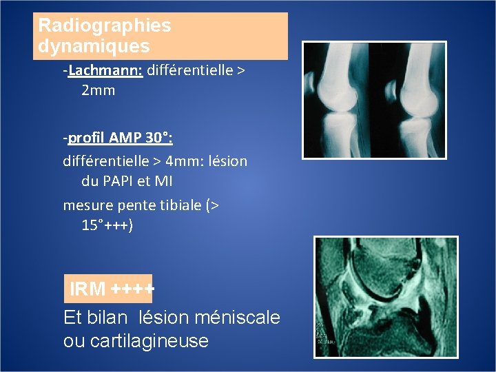 Radiographies dynamiques -Lachmann: différentielle > 2 mm -profil AMP 30°: différentielle > 4 mm: