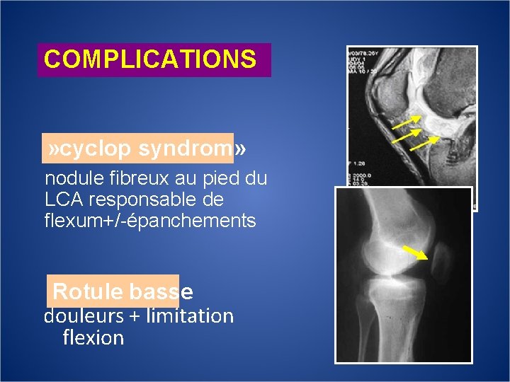 COMPLICATIONS » cyclop syndrom» nodule fibreux au pied du LCA responsable de flexum+/-épanchements Rotule