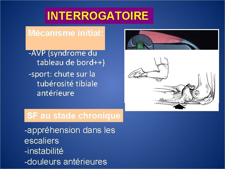 INTERROGATOIRE Mécanisme initial: -AVP (syndrome du tableau de bord++) -sport: chute sur la tubérosité