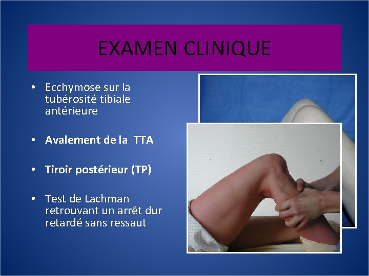 EXAMEN CLINIQUE • Ecchymose sur la tubérosité tibiale antérieure • Avalement de la TTA