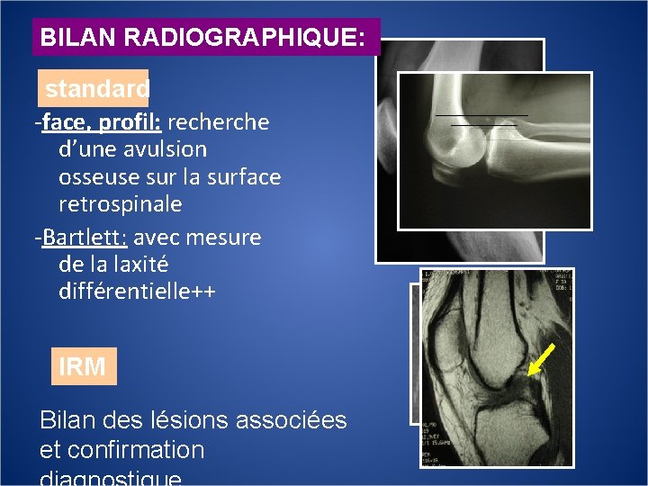 BILAN RADIOGRAPHIQUE: standard -face, profil: recherche d’une avulsion osseuse sur la surface retrospinale -Bartlett: