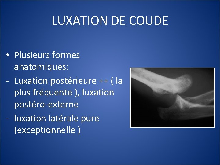 LUXATION DE COUDE • Plusieurs formes anatomiques: - Luxation postérieure ++ ( la plus
