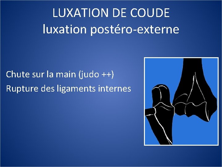 LUXATION DE COUDE luxation postéro-externe Chute sur la main (judo ++) Rupture des ligaments