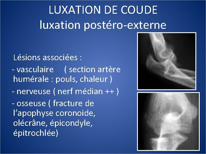 LUXATION DE COUDE luxation postéro-externe Lésions associées : - vasculaire ( section artère humérale