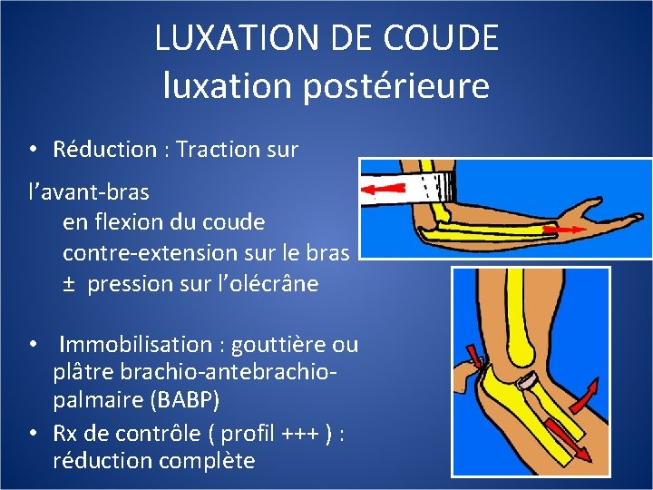 LUXATION DE COUDE luxation postérieure • Réduction : Traction sur l’avant-bras en flexion du