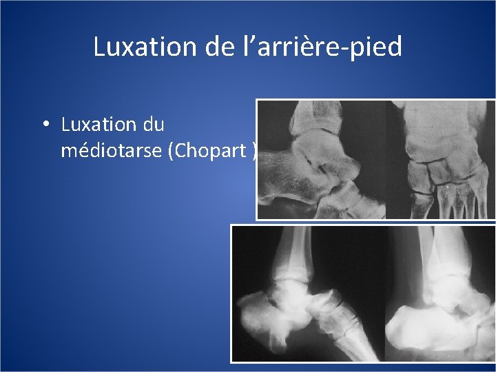 Luxation de l’arrière-pied • Luxation du médiotarse (Chopart ) 