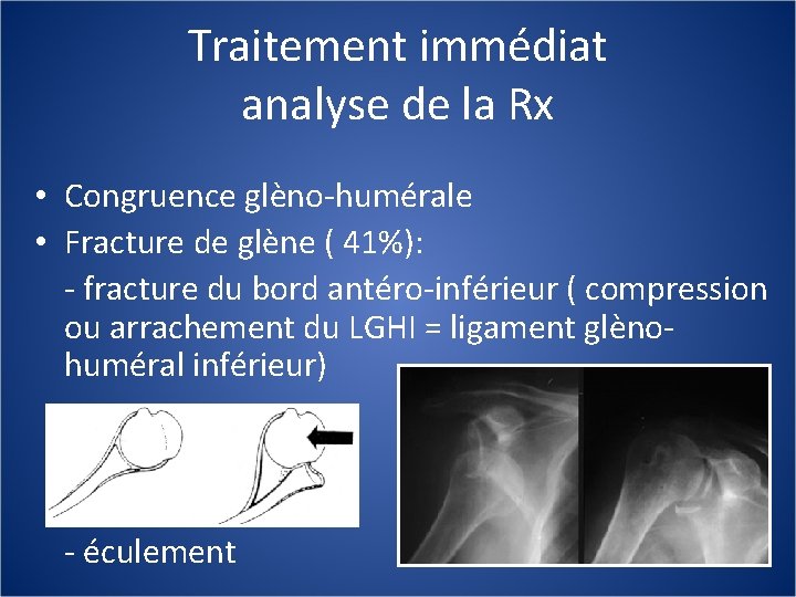 Traitement immédiat analyse de la Rx • Congruence glèno-humérale • Fracture de glène (