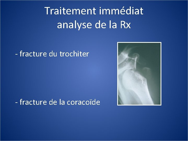 Traitement immédiat analyse de la Rx - fracture du trochiter - fracture de la