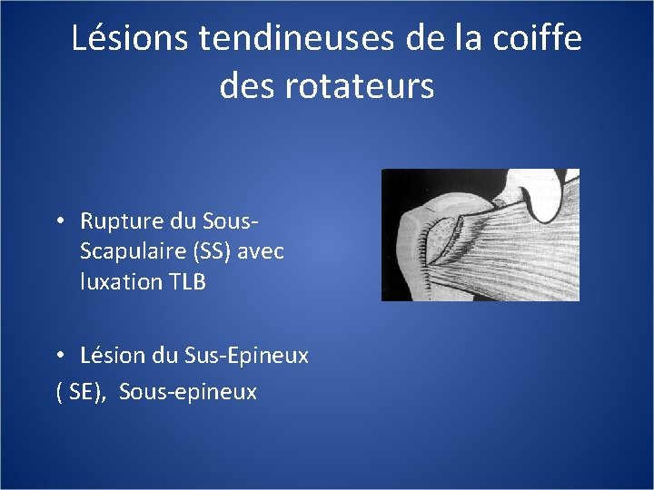 Lésions tendineuses de la coiffe des rotateurs • Rupture du Sous. Scapulaire (SS) avec