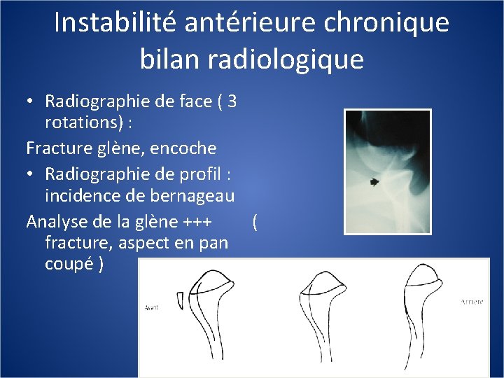 Instabilité antérieure chronique bilan radiologique • Radiographie de face ( 3 rotations) : Fracture