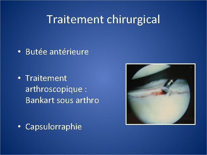 Traitement chirurgical • Butée antérieure • Traitement arthroscopique : Bankart sous arthro • Capsulorraphie