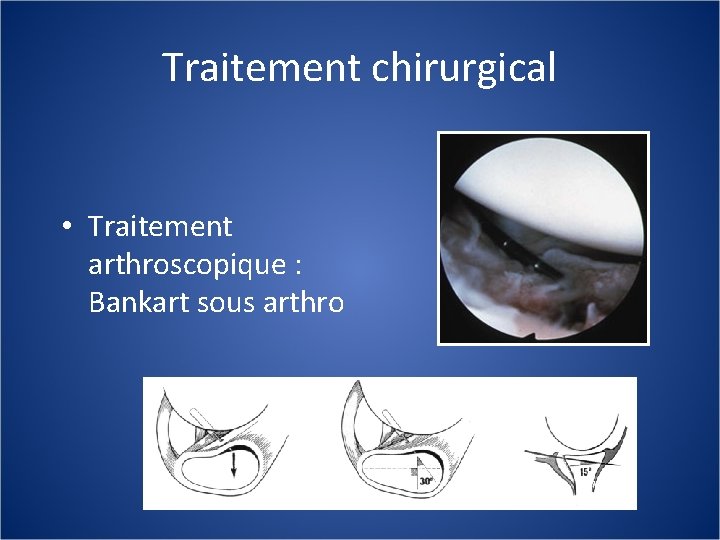 Traitement chirurgical • Traitement arthroscopique : Bankart sous arthro 