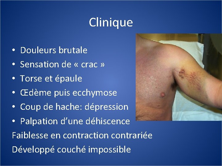 Clinique • Douleurs brutale • Sensation de « crac » • Torse et épaule