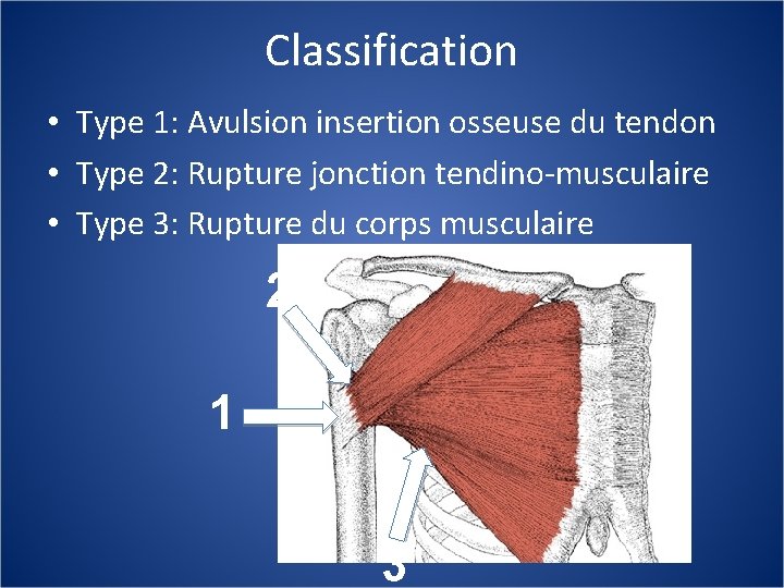 Classification • Type 1: Avulsion insertion osseuse du tendon • Type 2: Rupture jonction