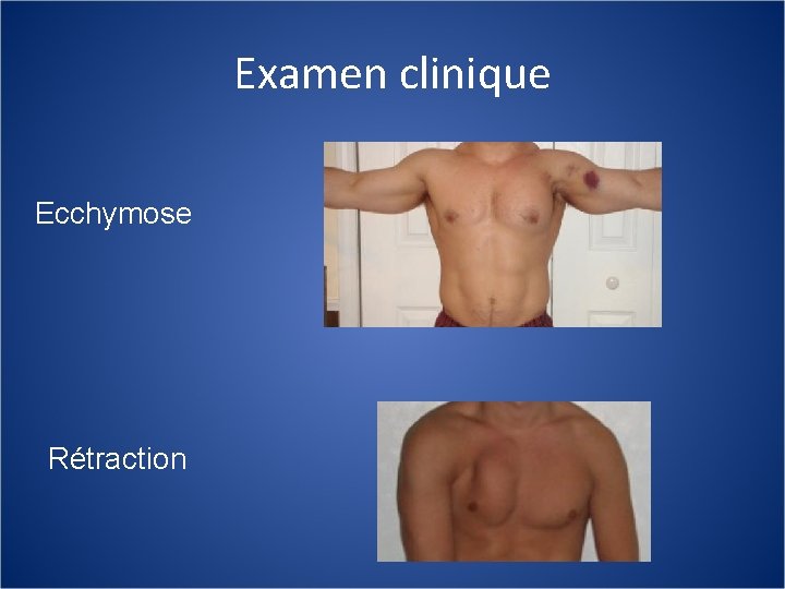 Examen clinique Ecchymose Rétraction 