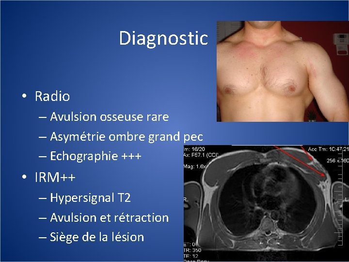 Diagnostic • Radio – Avulsion osseuse rare – Asymétrie ombre grand pec – Echographie