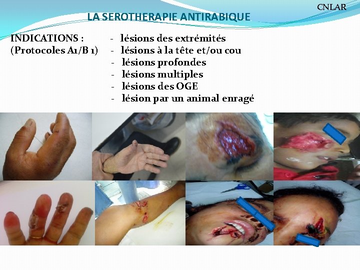 LA SEROTHERAPIE ANTIRABIQUE INDICATIONS : (Protocoles A 1/B 1) - lésions des extrémités lésions