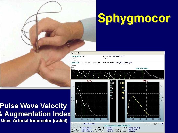 Sphygmocor Pulse Wave Velocity & Augmentation Index Uses Arterial tonometer (radial) 