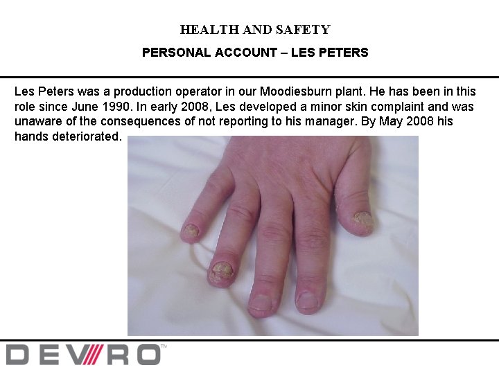 HEALTH AND SAFETY PERSONAL ACCOUNT – LES PETERS Les Peters was a production operator HEALTH AND SAFETY PERSONAL ACCOUNT – LES PETERS Les Peters was a production operator