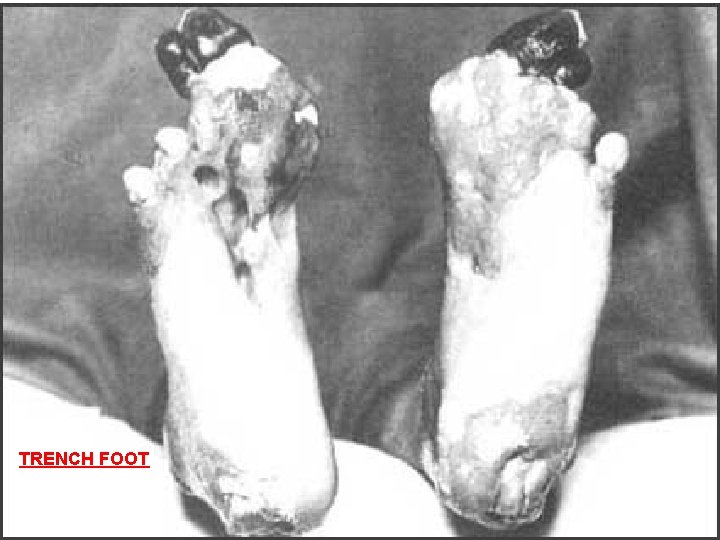 TRENCH FOOT 