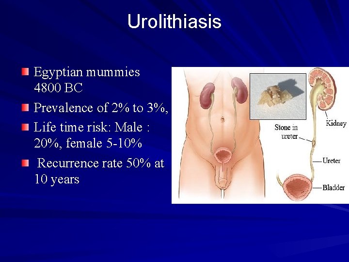 Urolithiasis Egyptian mummies 4800 BC Prevalence of 2% to 3%, Life time risk: Male