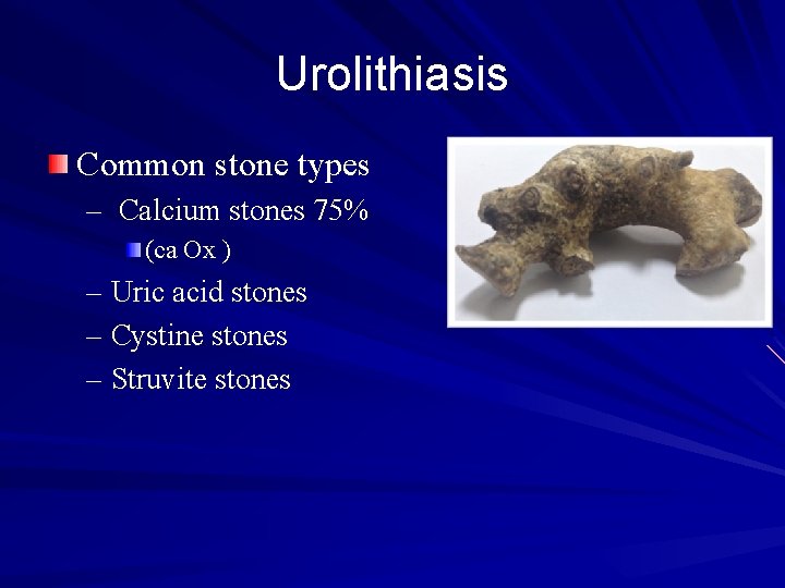 Urolithiasis Common stone types – Calcium stones 75% (ca Ox ) – Uric acid