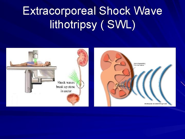 Extracorporeal Shock Wave lithotripsy ( SWL) 