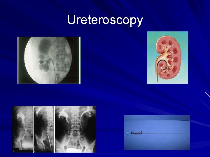 Ureteroscopy 