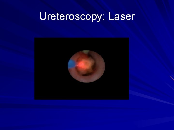 Ureteroscopy: Laser 