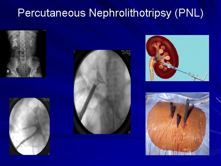 Percutaneous Nephrolithotripsy (PNL) 