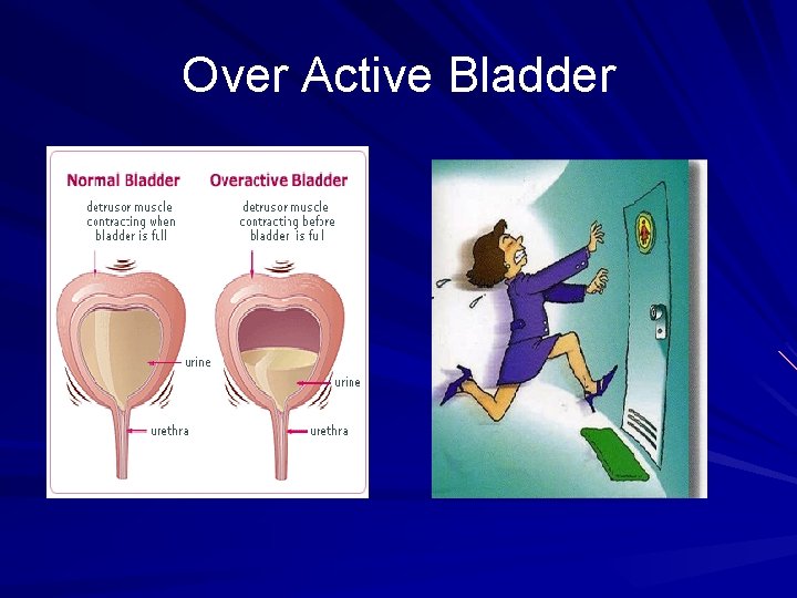 Over Active Bladder 