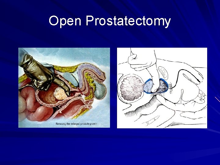 Open Prostatectomy 
