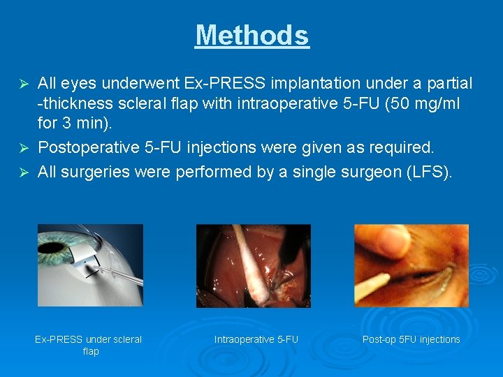 Methods All eyes underwent Ex-PRESS implantation under a partial -thickness scleral flap with intraoperative