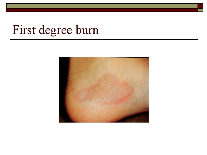 First degree burn 