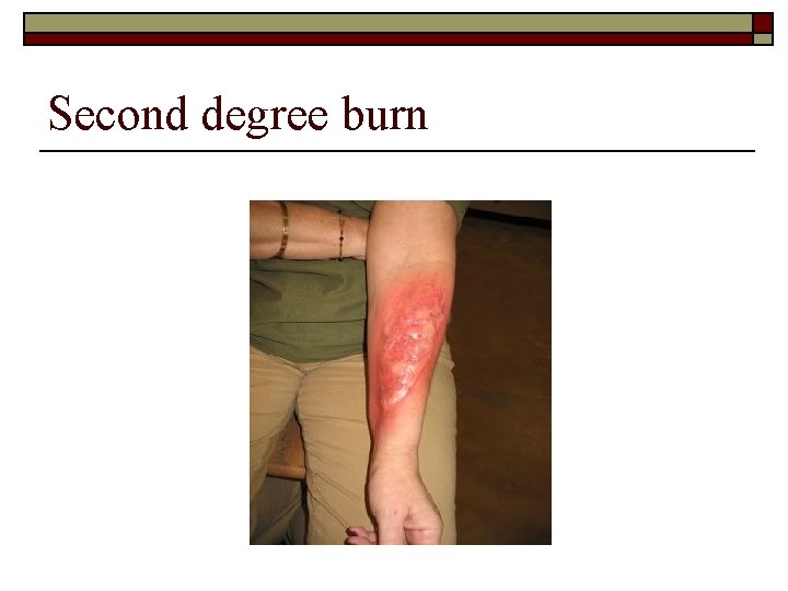 Second degree burn 