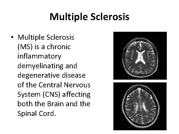 Multiple Sclerosis • Multiple Sclerosis (MS) is a chronic inflammatory demyelinating and degenerative disease