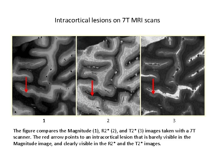 Intracortical lesions on 7 T MRI scans 1 2 3 The figure compares the