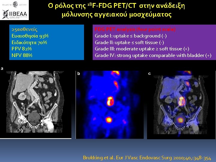 Ο ρόλος της 18 F-FDG PET/CT στην ανάδειξη μόλυνσης αγγειακού μοσχεύματος 25ασθενείς Ευαισθησία 93%