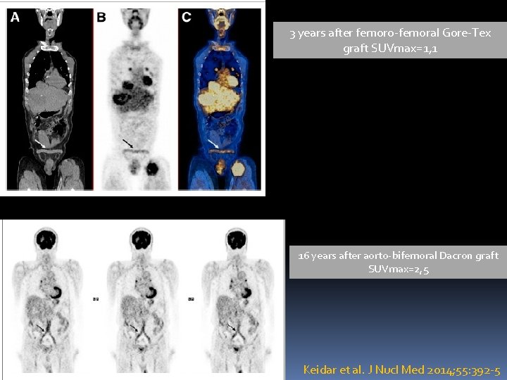 3 years after femoro-femoral Gore-Tex graft SUVmax=1, 1 16 years after aorto-bifemoral Dacron graft