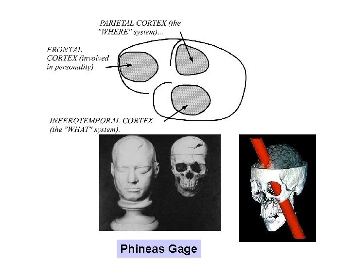 Phineas Gage 