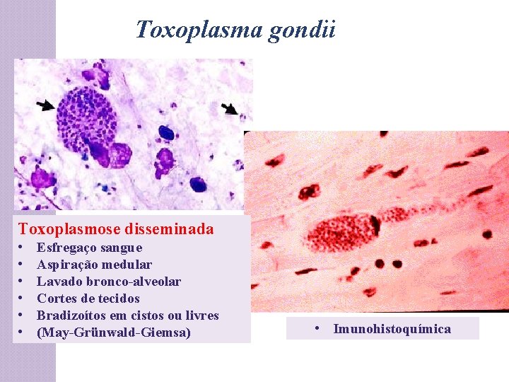 Toxoplasma gondii Toxoplasmose disseminada • • • Esfregaço sangue Aspiração medular Lavado bronco-alveolar Cortes