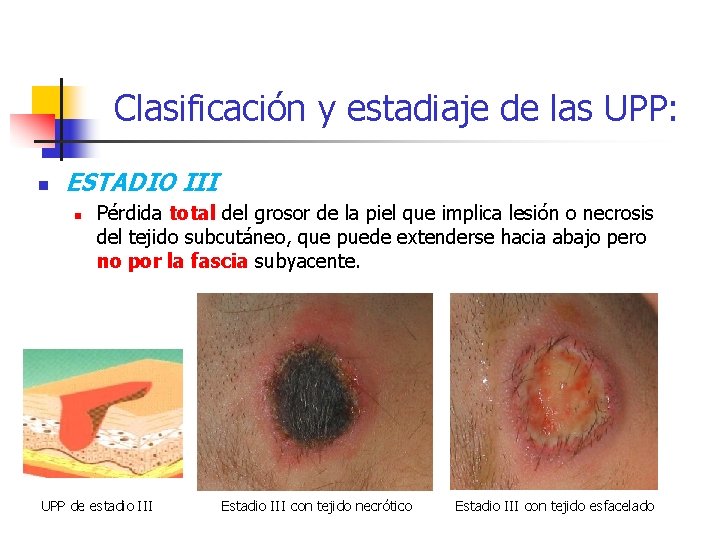 Clasificación y estadiaje de las UPP: n ESTADIO III n Pérdida total del grosor