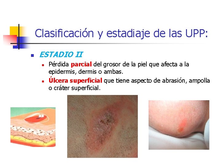 Clasificación y estadiaje de las UPP: n ESTADIO II n n Pérdida parcial del