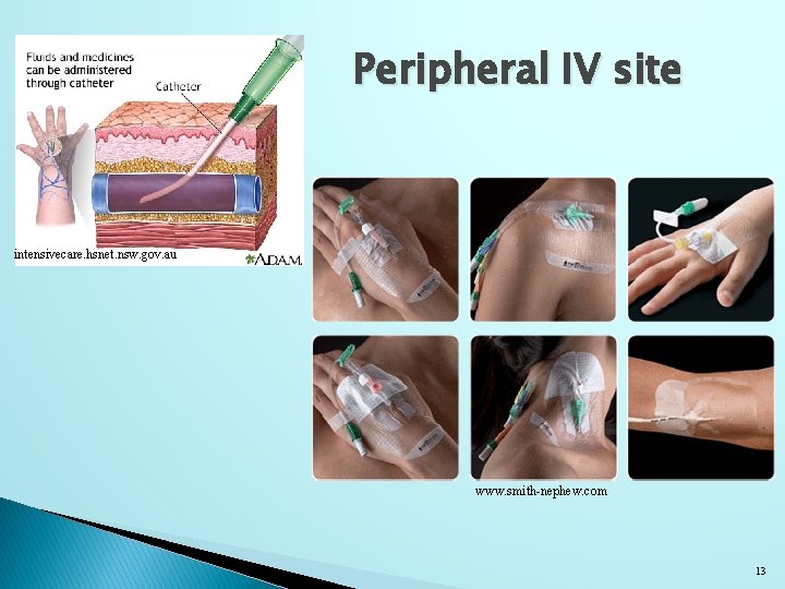 Peripheral IV site intensivecare. hsnet. nsw. gov. au www. smith-nephew. com 13 