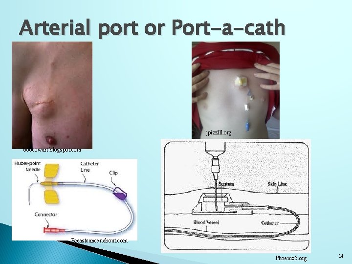 Arterial port or Port-a-cath jpizzlll. org bobcowart. blogspot. com Breastcancer. about. com Phoenix 5.