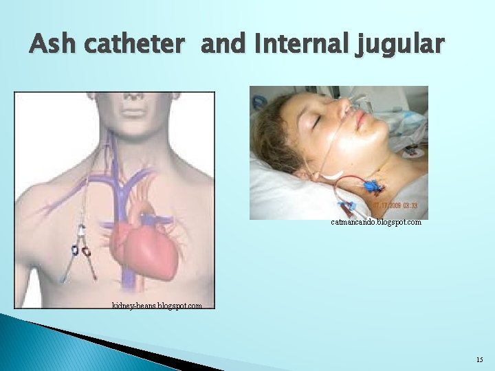 Ash catheter and Internal jugular catmancando. blogspot. com kidney-beans. blogspot. com 15 
